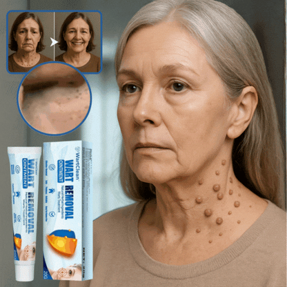 WartClean™ – Hurtig & Skånsom Vortefjerner