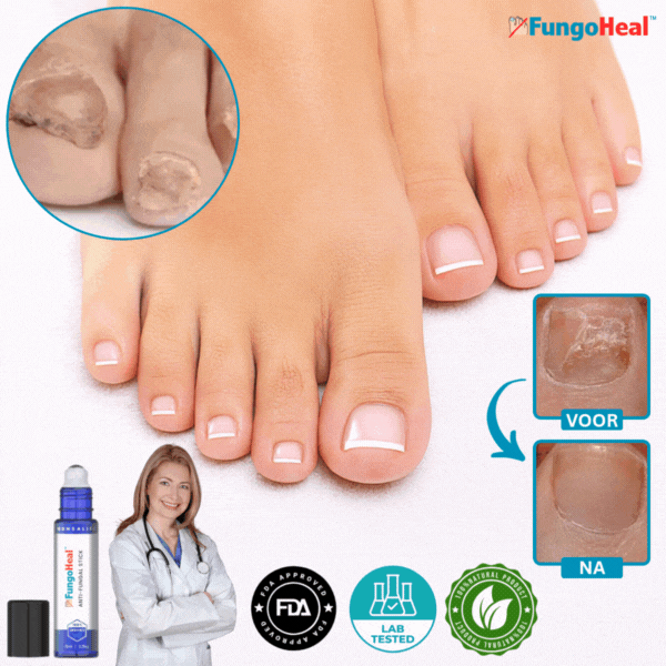 FungoHeal™ – Hurtigtvirkende Naturlig Anti-Svampespray