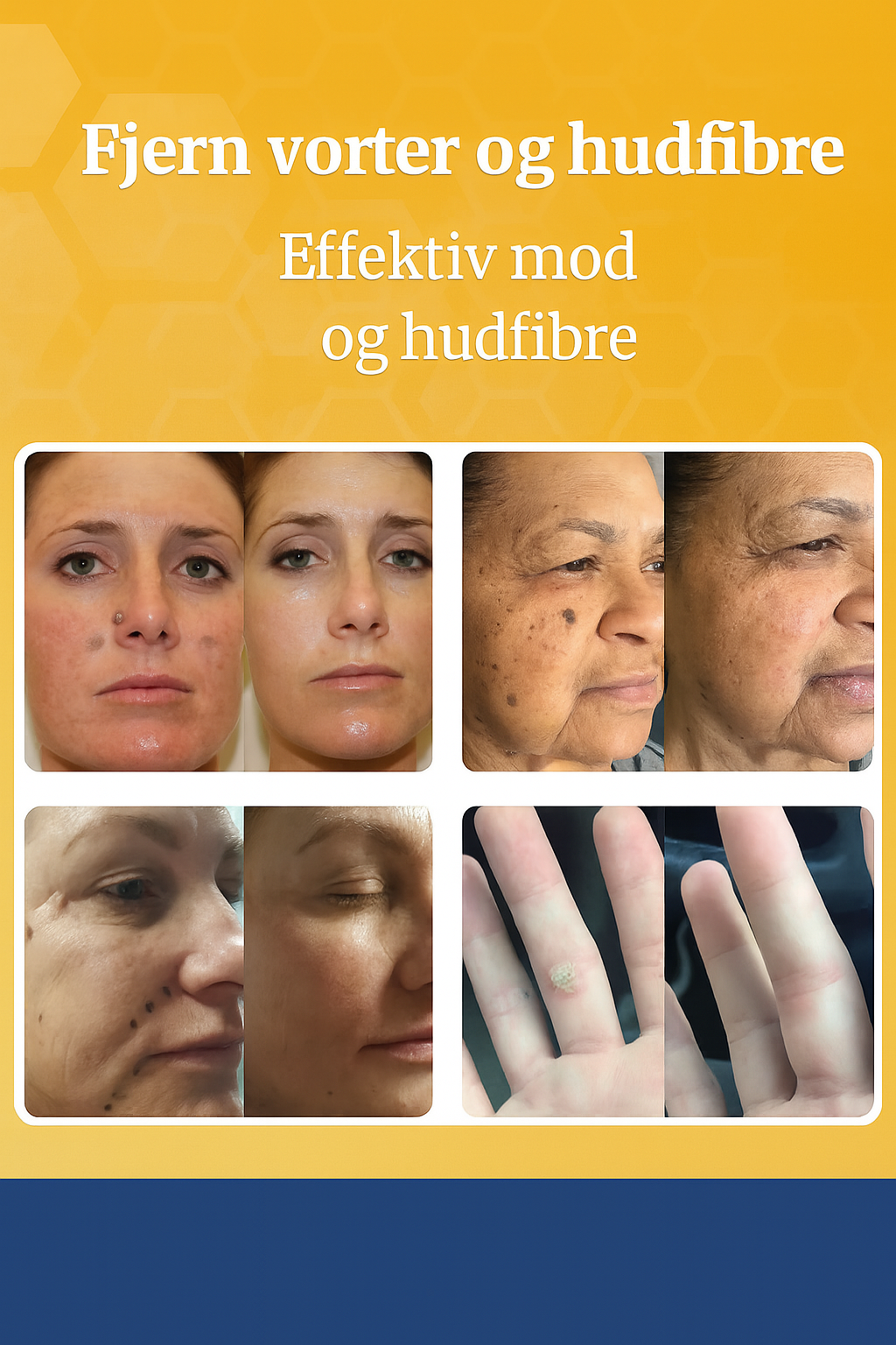 NovaBee™ – Fjern vorter og hudproblemer naturligt på 1–2 uger