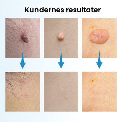 Nova Remover™ Kit – Fjern hudflapper sikkert og nemt derhjemme