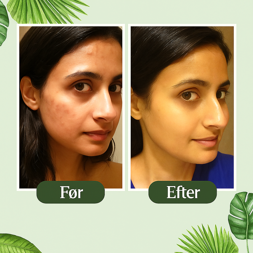 Nova Green Tea Mask™ | Farvel til acne og hudorme