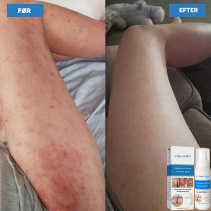 DermaBoost™ | Beroligende Spray til Rødme & Irritationsfølsom Hud