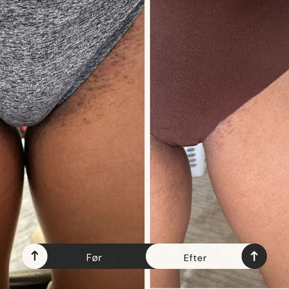 VagiSafe™ – Frihed fra kløe på bare 72 timer