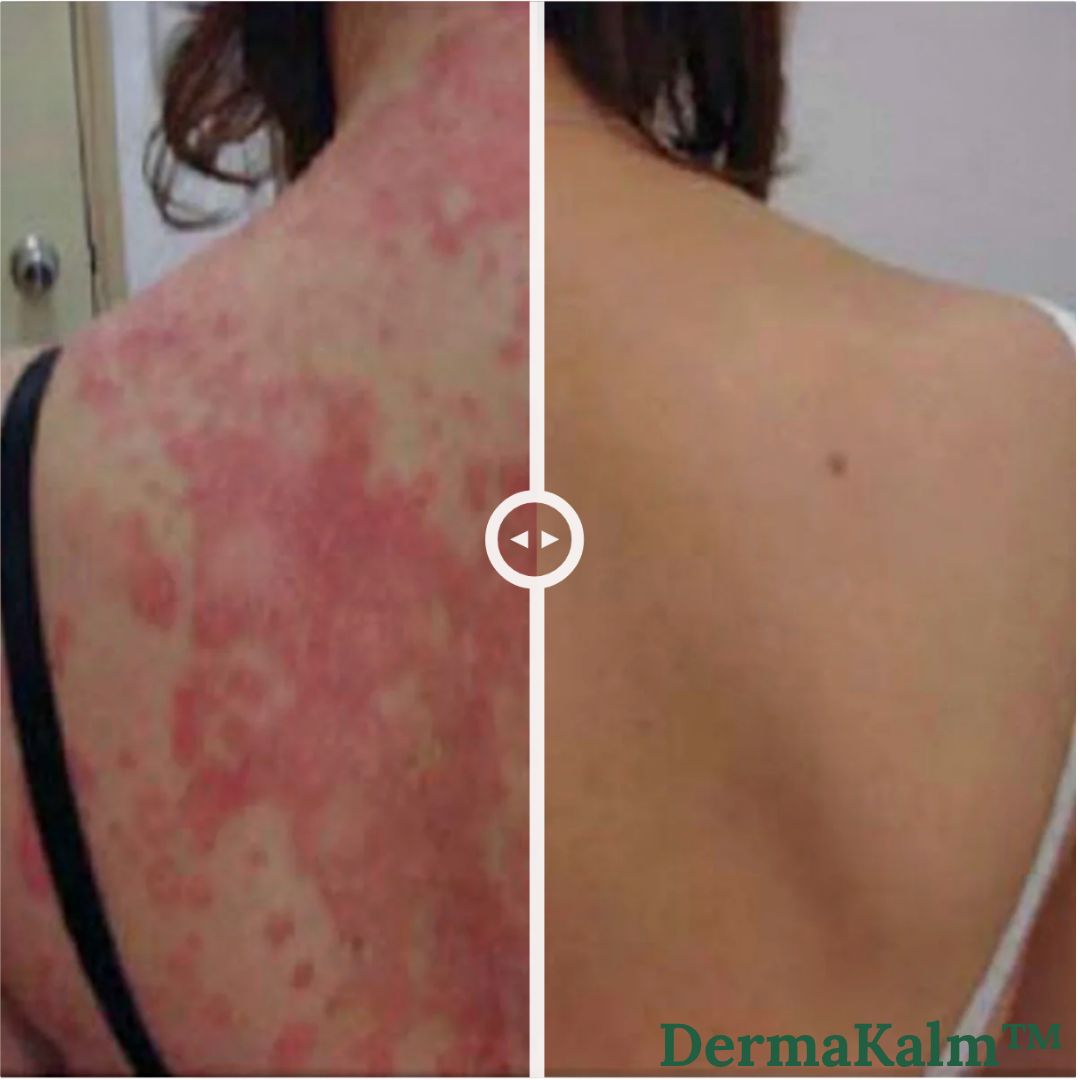 DermaKalm™ | Stop eksem og genopret sund hud på kun 2 dage