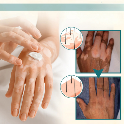 NovaFix™ – Gendan din naturlige hudfarve på 3 uger