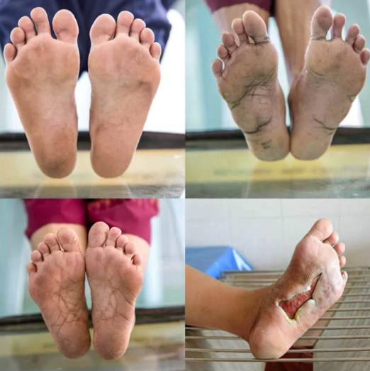 DiabeGone® – Naturlig blodsukkerstøtte