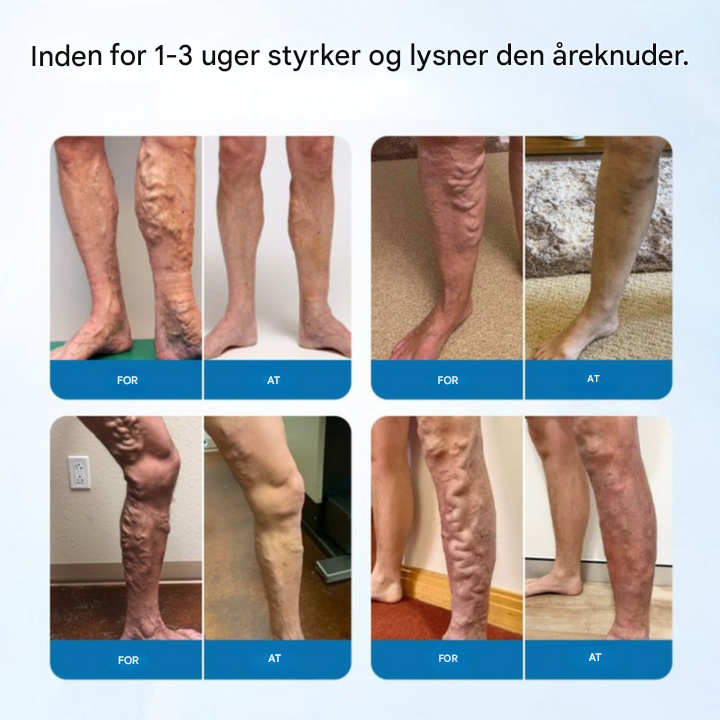 NovaRelief Spray™ Cirkulation & åreknudercreme