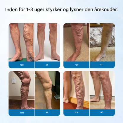 NovaRelief Spray™ Cirkulation & åreknudercreme