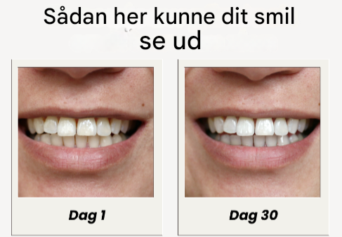 NovaSmile™ SmartBrush – Automatisk tandbørste til tandblegning